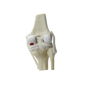 JOELHO COM OSTEOARTRITE INÍCIO - cód. 9597-2