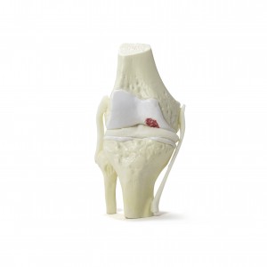 JOELHO COM OSTEOARTRITE INÍCIO - cód. 9597-2