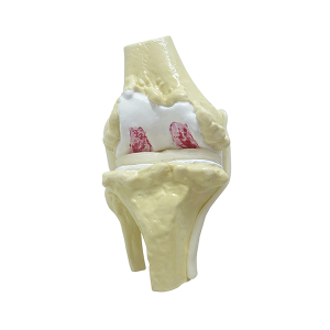 JOELHO COM OSTEOARTRITE AVANÇADO - cód. 9597-4