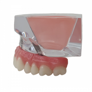 MAXILA ACRÍLICA COM IMPLANTES ANGULADOS E SEIO MAXILAR - cod 14900
