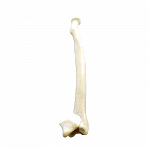 RÁDIO ESQUERDO COM FRATURA DISTAL INTRA ARTICULAR COM DESVIO - cód. 10054