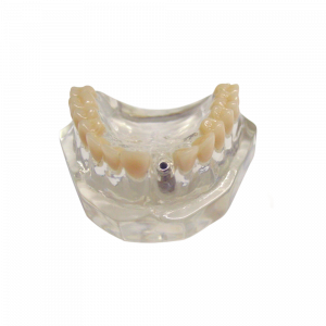 MAXILA ACRILICA COM DENTES E 1 IMPLANTE - cód. 4217 A