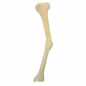 TIBIA ESQUERDA COM DEFORMIDADE MEDIAL E MÁ CALCIFICAÇÃO - cód. 2026 DMMC