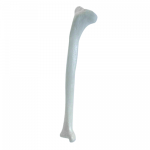TIBIA DIREITA COM DEFORMIDADE PROXIMAL SMA - cód. 2031 DP