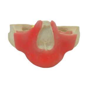 MAXILA EDENTULA REABSORVIDA C/ GENGIVA II - cód. 13410G
