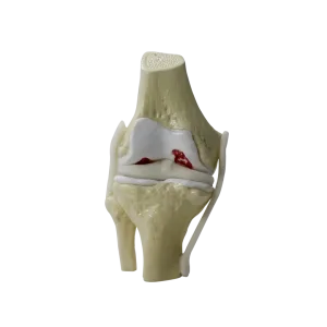 JOELHO COM OSTEOARTRITE MODERADO - cód. 9597-3