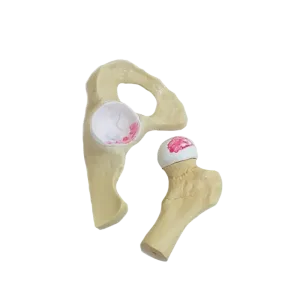 QUADRIL COM OSTEOARTRITE MODERADO - cód. 9598-3
