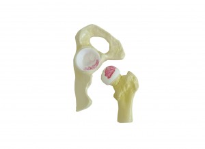 QUADRIL COM OSTEOARTRITE MODERADO - cód. 9598-3