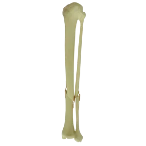 TÍBIA COM CANAL MEDULAR E ESPONSOJO COM FÍBULA - FRATURA 2 - ESQUERDA - cód. 9701